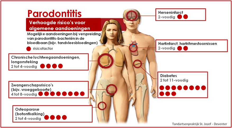 Parodontitis-Tandartsenpraktijk-St.-Jozef-Deventer-klein